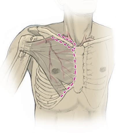 pectoralis major lappen|Gestielte und freie Lappen zur Rekonstruktion des Kopf